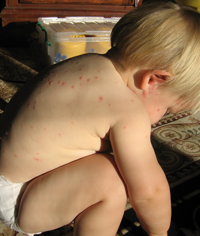 chickenpox1.jpg